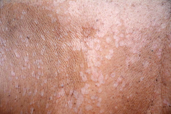 เกลื้อน