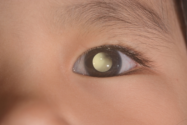 มะเร็งลูกตาในเด็ก,Retinoblastoma
