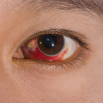 เลือดออกใต้ตาขาว