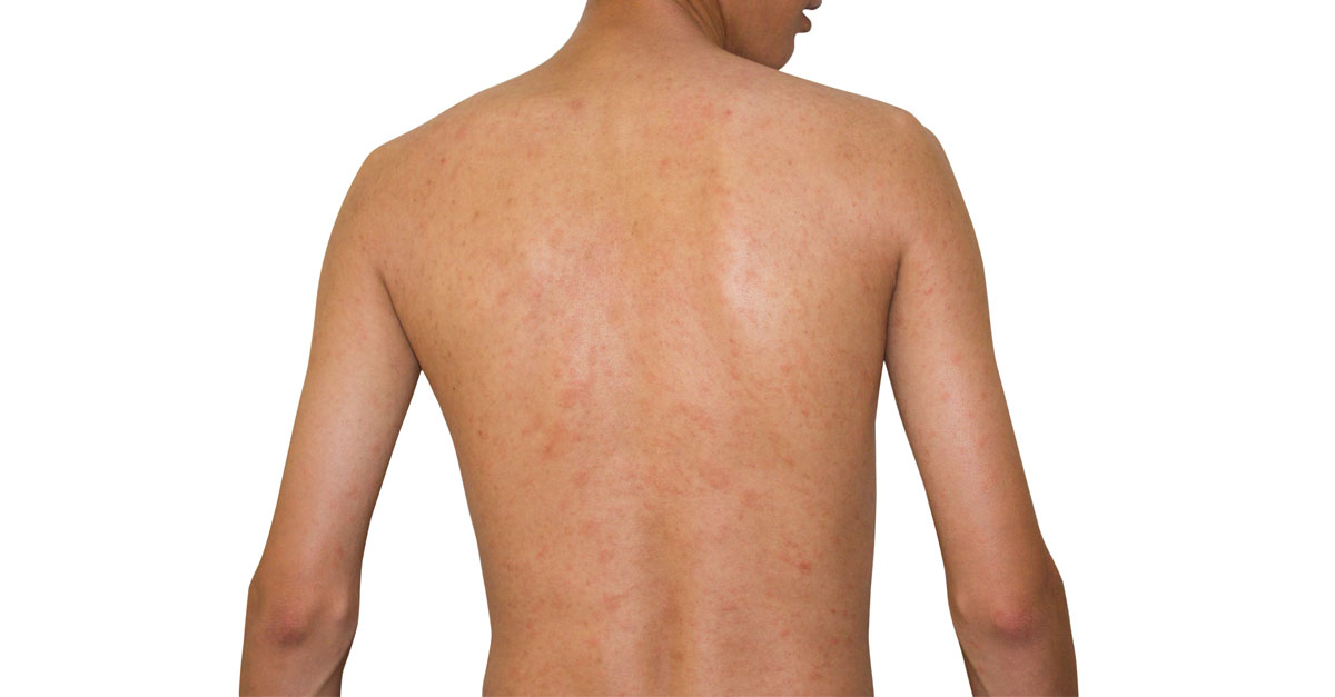 ผื่นพีอาร์,ผื่นกลีบกุหลาบ