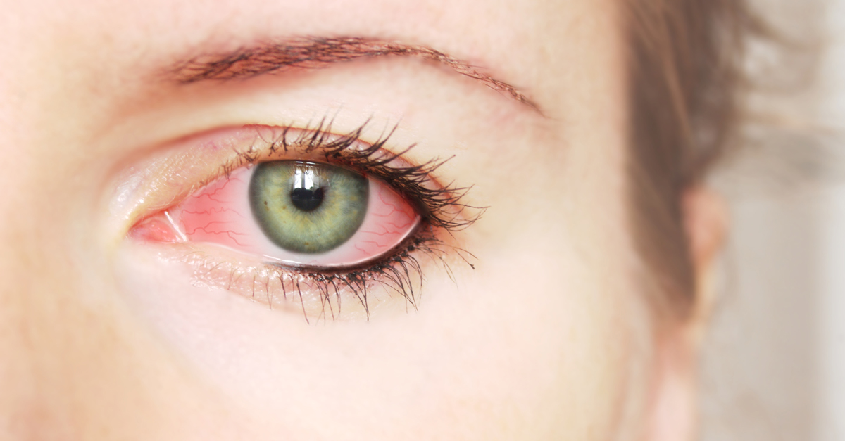 เยื่อตาขาวอักเสบจากการแพ้