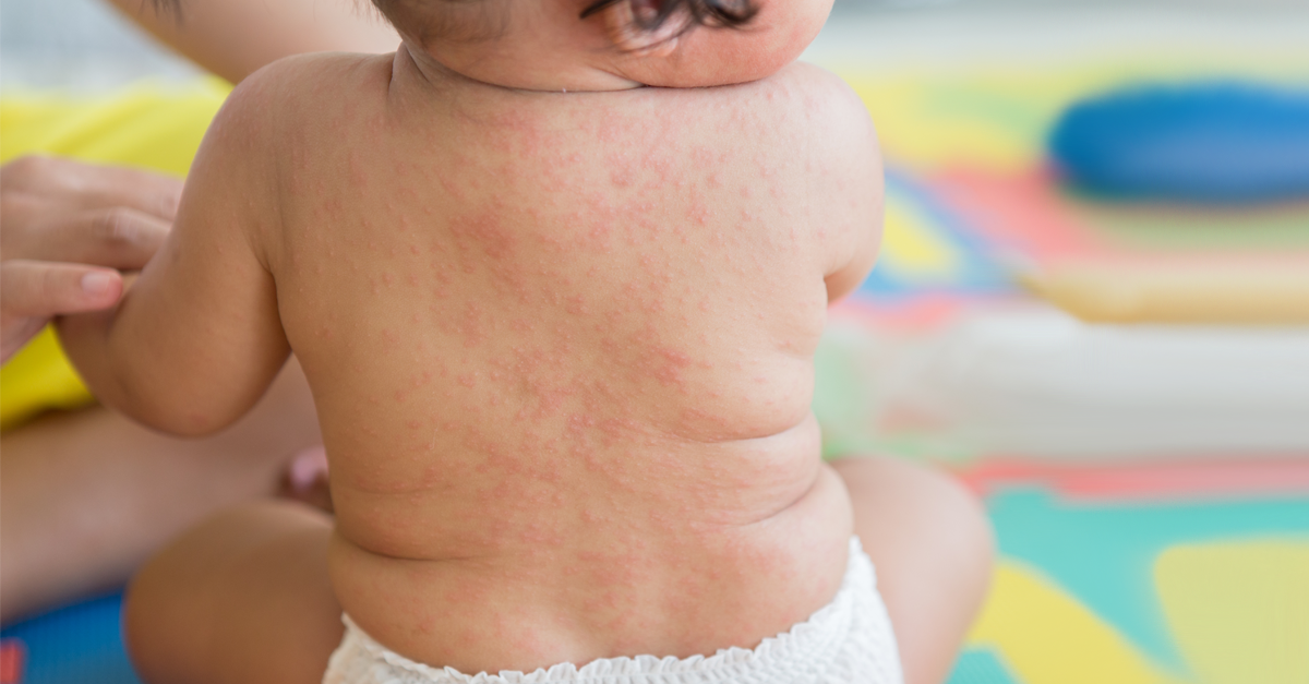 ไข้ผื่นกุหลาบในทารก,ส่าไข้,หัดดอกกุหลาบ