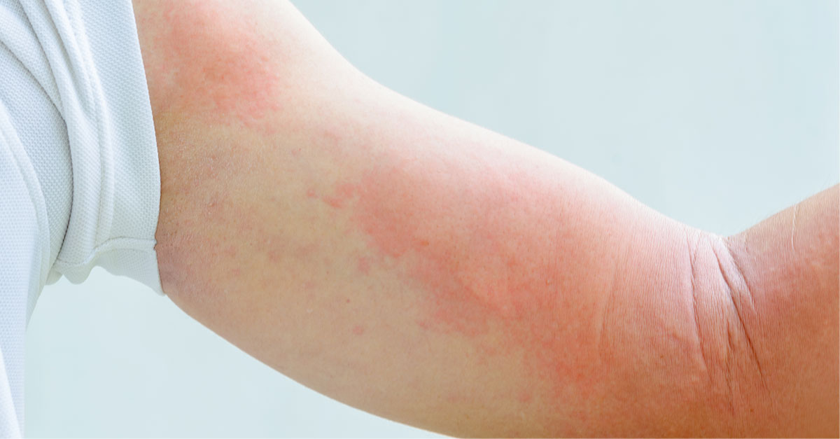 ลมพิษ,ลมพิษยักษ์,แพ้อาหาร