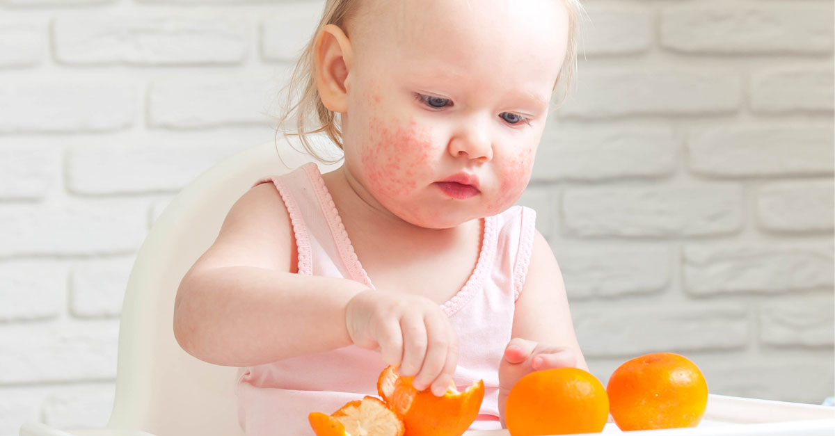 ผิวหนังอักเสบจากภูมิแพ้,ผิวหนังอักเสบ