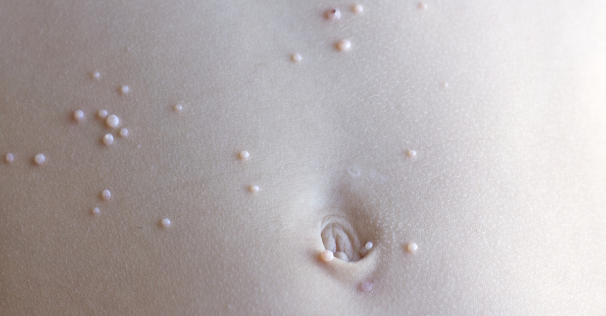 หูดข้าวสุก,หูด