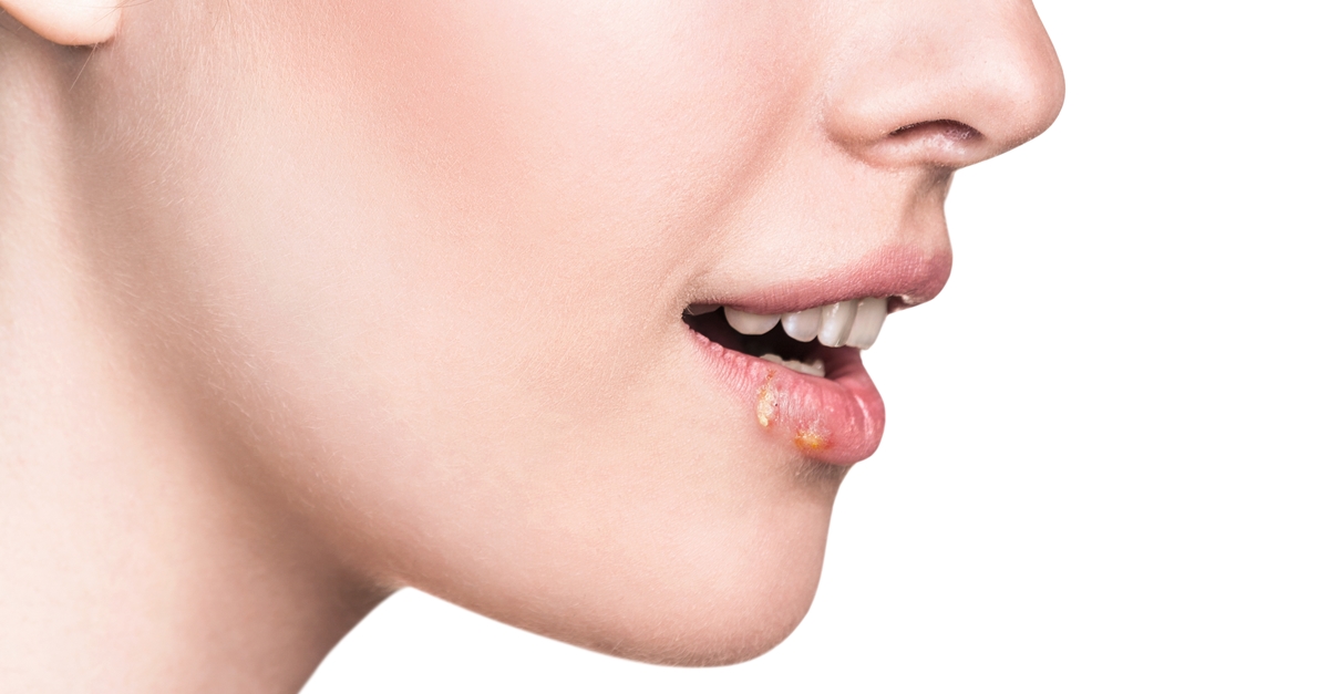 เริม,ขยุ้มตีนหมา,ตะมอยเริม,เริมที่ผิวหนัง,เริมในช่องปาก,เริมที่อวัยวะเพศ,เริมที่ริมฝีปาก