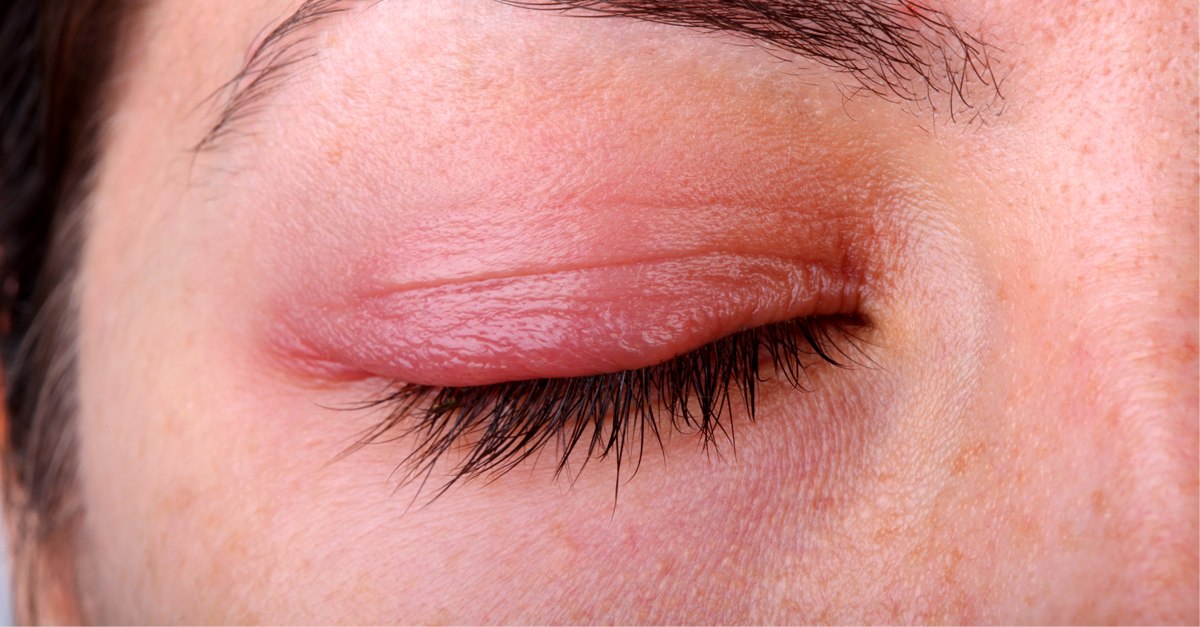 หนังตาอักเสบ,เปลือกตาอักเสบ