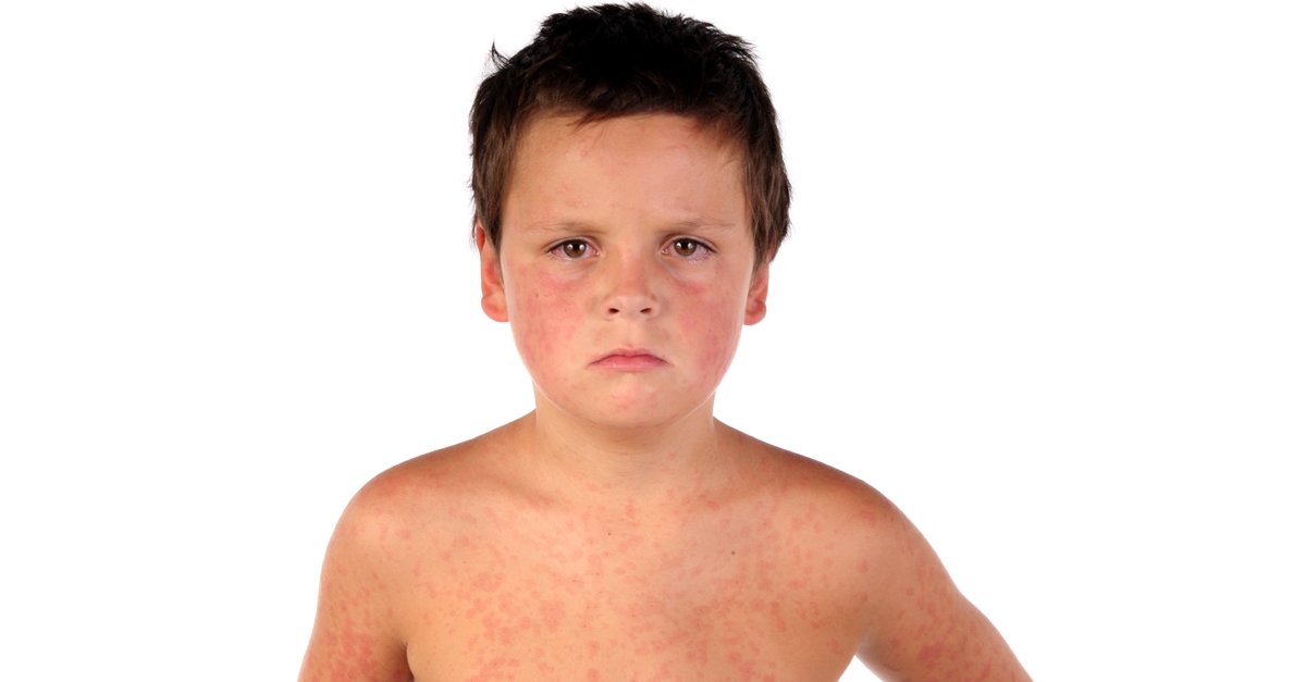 กลุ่มอาการสตีเวนส์จอห์นสัน