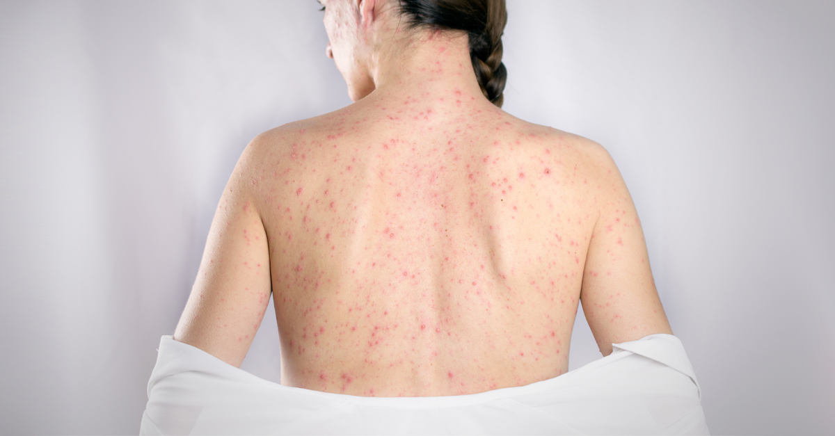 หัดเยอรมัน,เหือด