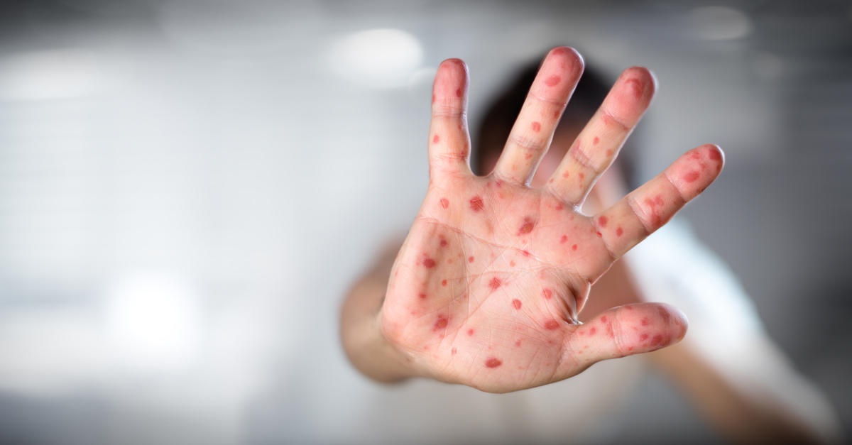 โรคมือเท้าปาก