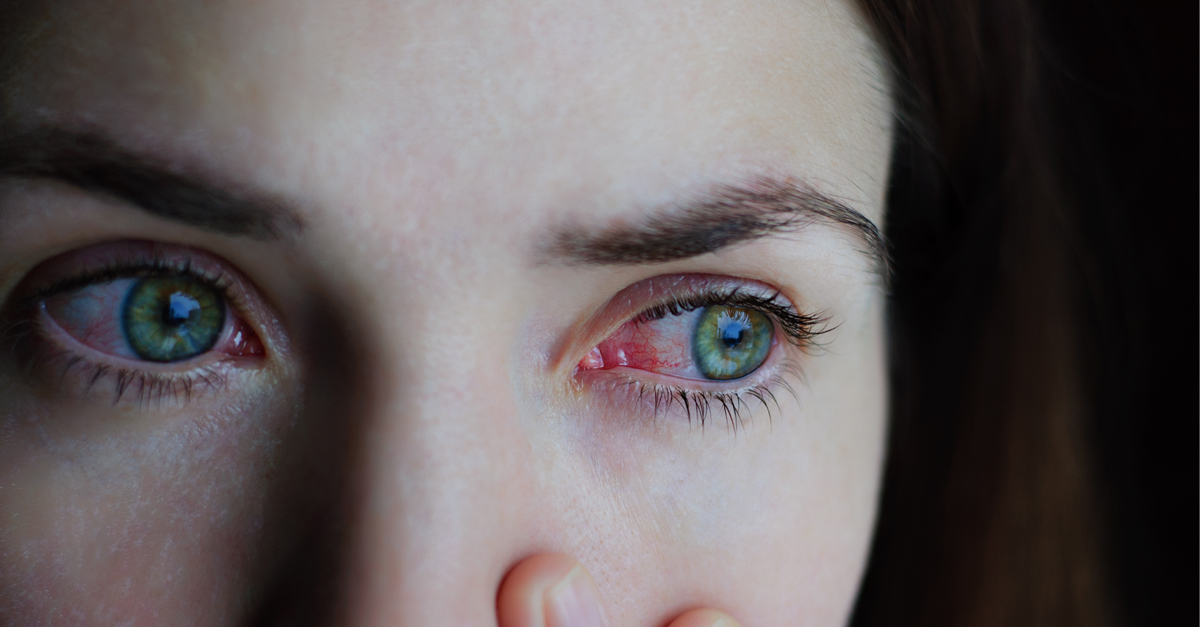 ม่านตาอักเสบ