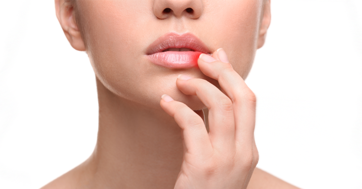 แผลเปื่อยที่ปาก,ปากเป็นแผล