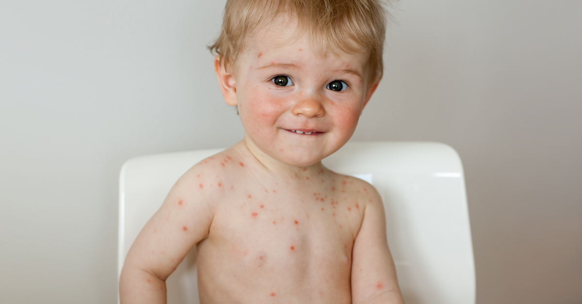 อีสุกอีใส,ไข้สุกใส,โรคสุกใส