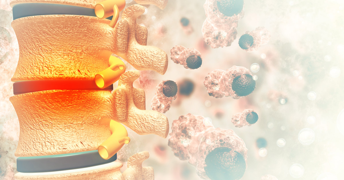 เนื้องอกไขสันหลัง