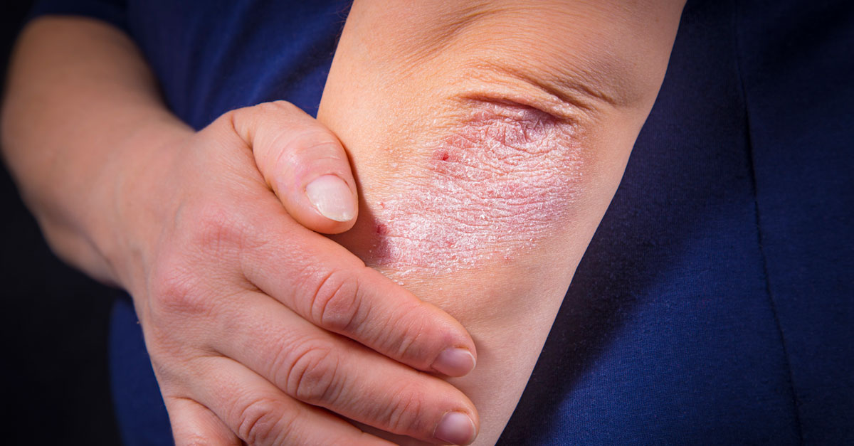 โซริอาซิส,โรคเกล็ดเงิน,โรคสะเก็ดเงิน