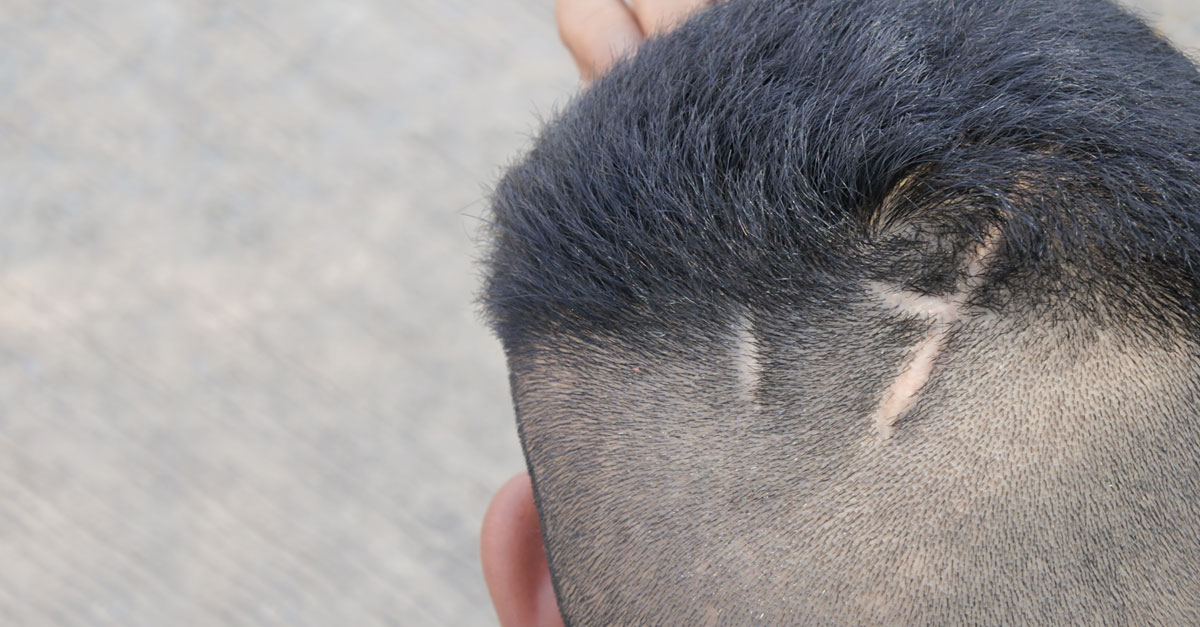 รอยแผลเป็นที่หนังศีรษะ