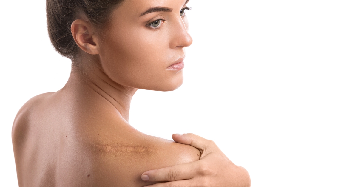 คีลอยด์,แผลปูด