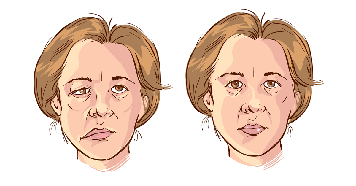 โรคหน้าเบี้ยวครึ่งซีก,อัมพาตเบลล์,เบลล์พัลซี,อัมพาตใบหน้าครึ่งซีก,อัมพาตหน้าครึ่งซีก,โรคกล้ามเนื้อใบหน้าอ่อนแรงครึ่งซีก,bell's palsy,Idiopathic facial paralysis