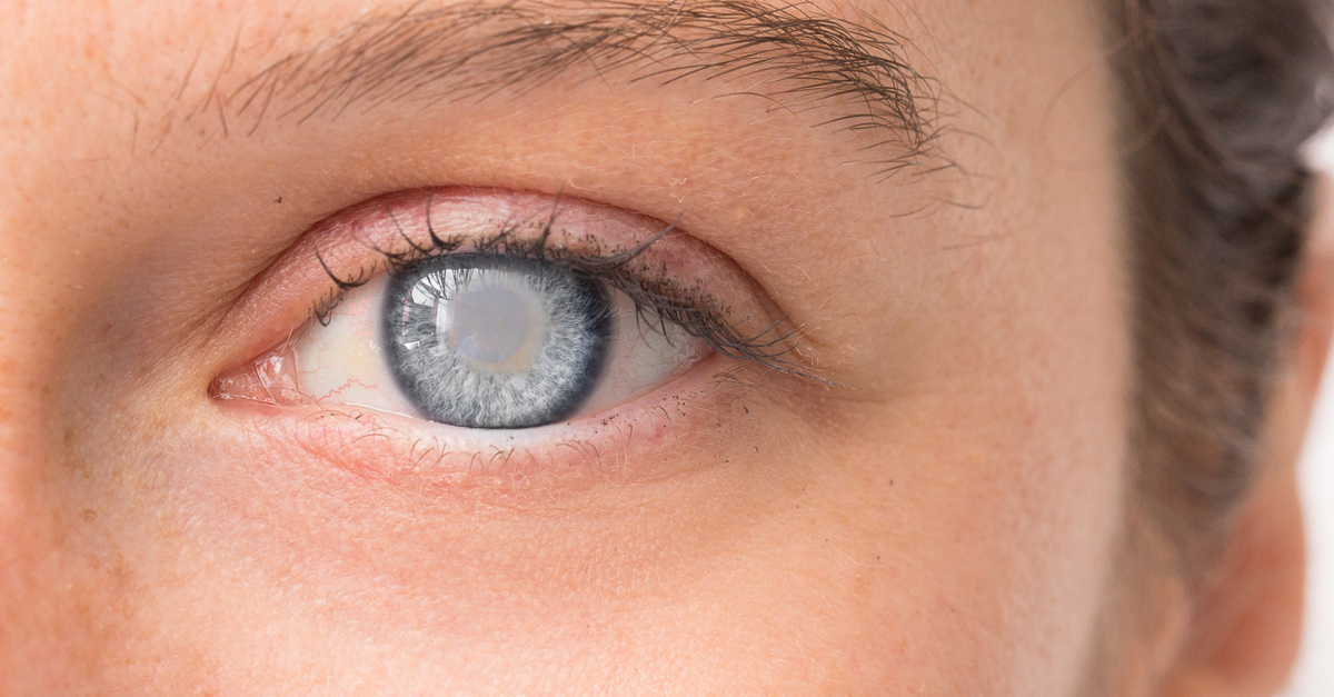 ต้อกระจก