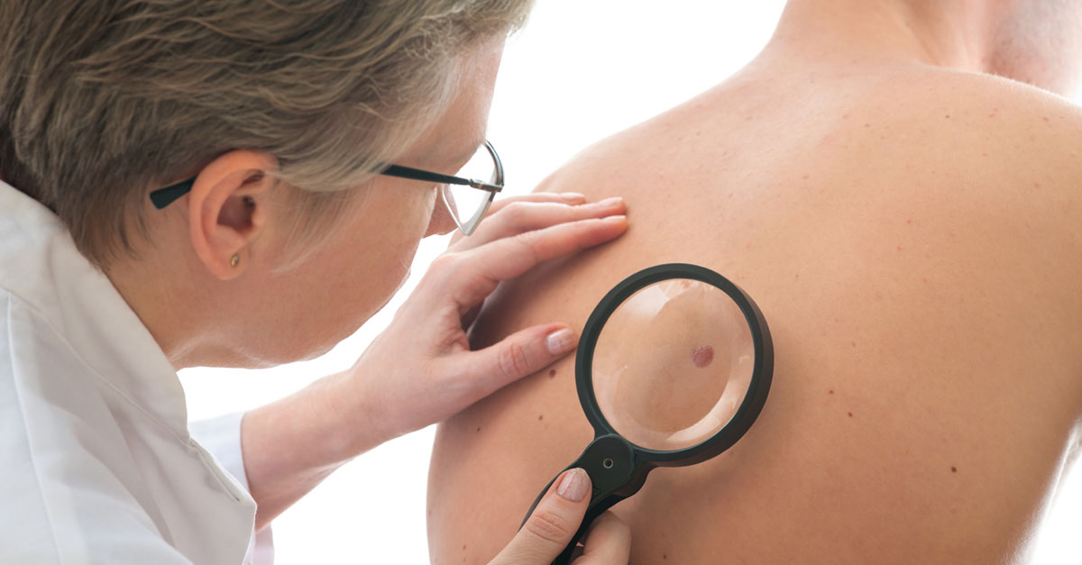 มะเร็งผิวหนัง