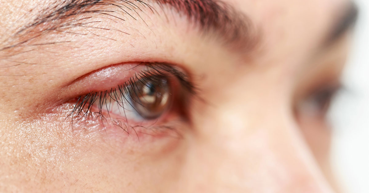 กุ้งยิง,ตากุ้งยิง,ตาเป็นซิสต์